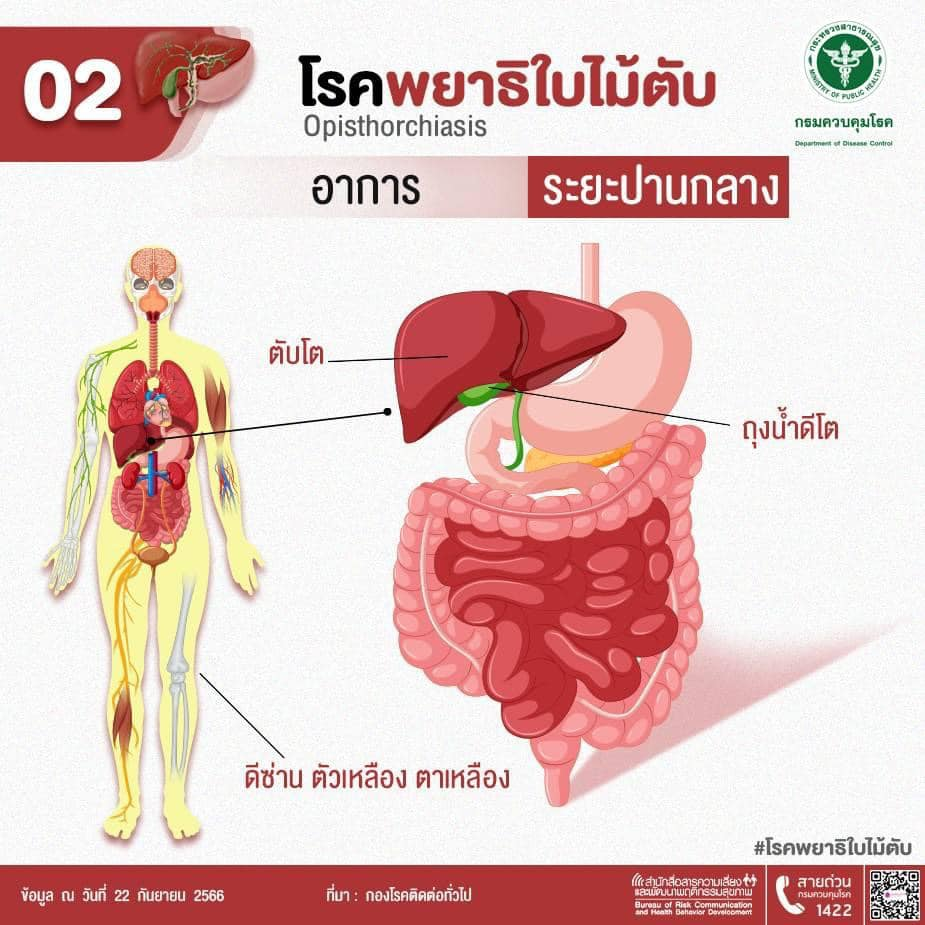 โรคพยาธิใบไม้ตับ (Opisthorchiasis) เกิดจากพยาธิใบไม้ตับ ซึ่งโรคนี้เป็นสาเหตุหลักของโรคมะเร็งท่อน้ำดีในคนไทย